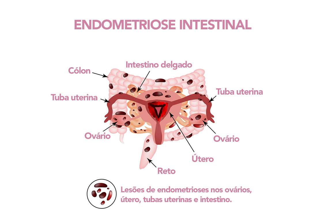 Endometriose intestinal