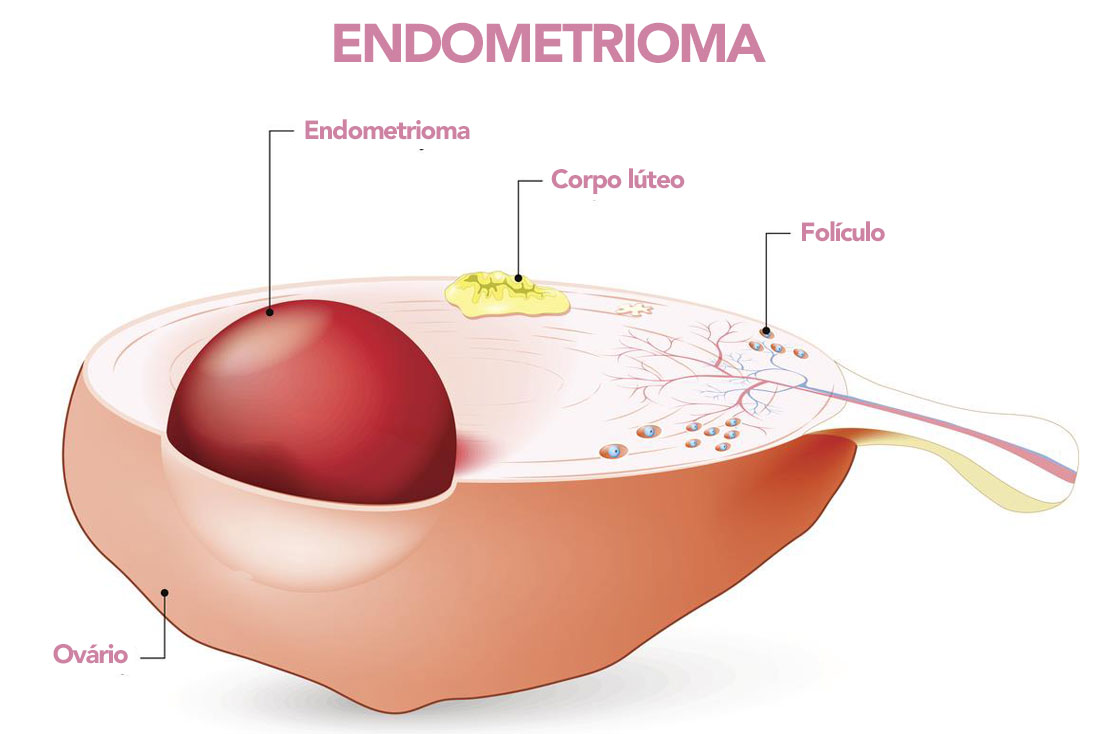 Endometriose - o que causa no corpo?