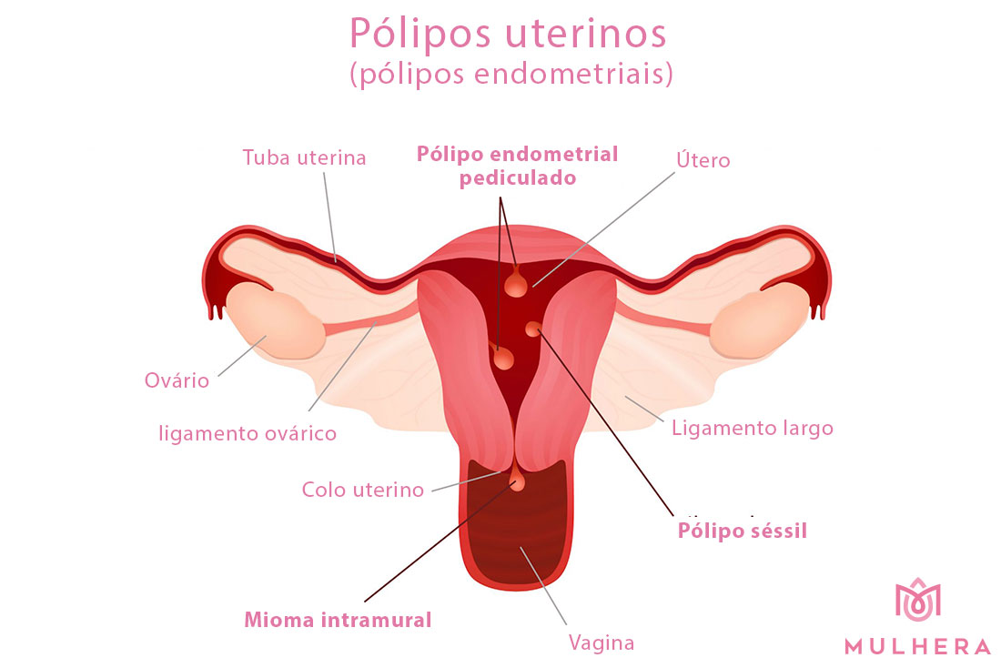 Pólipos endometriais