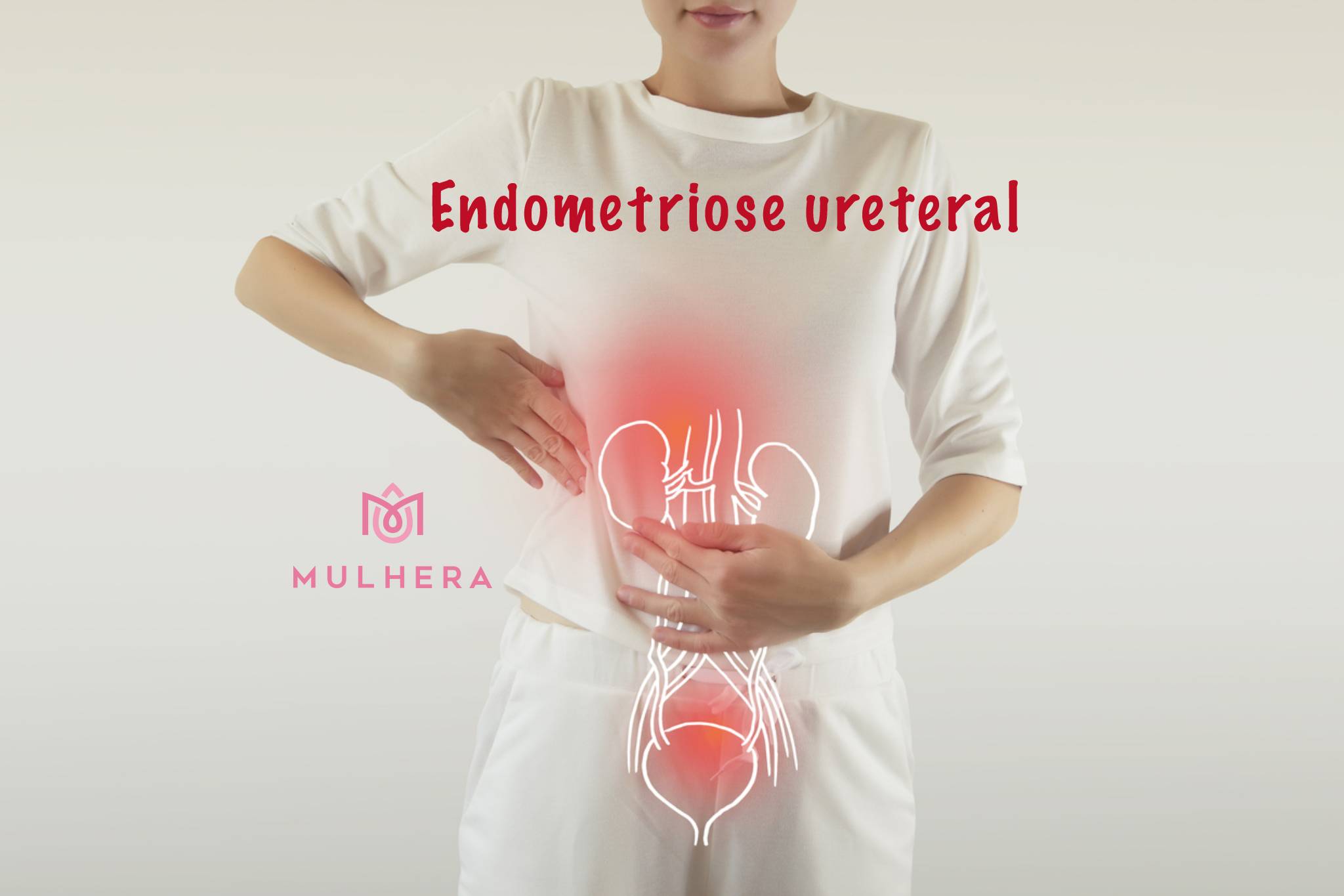 Endometriose ureteral