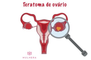 Teratoma de ovário