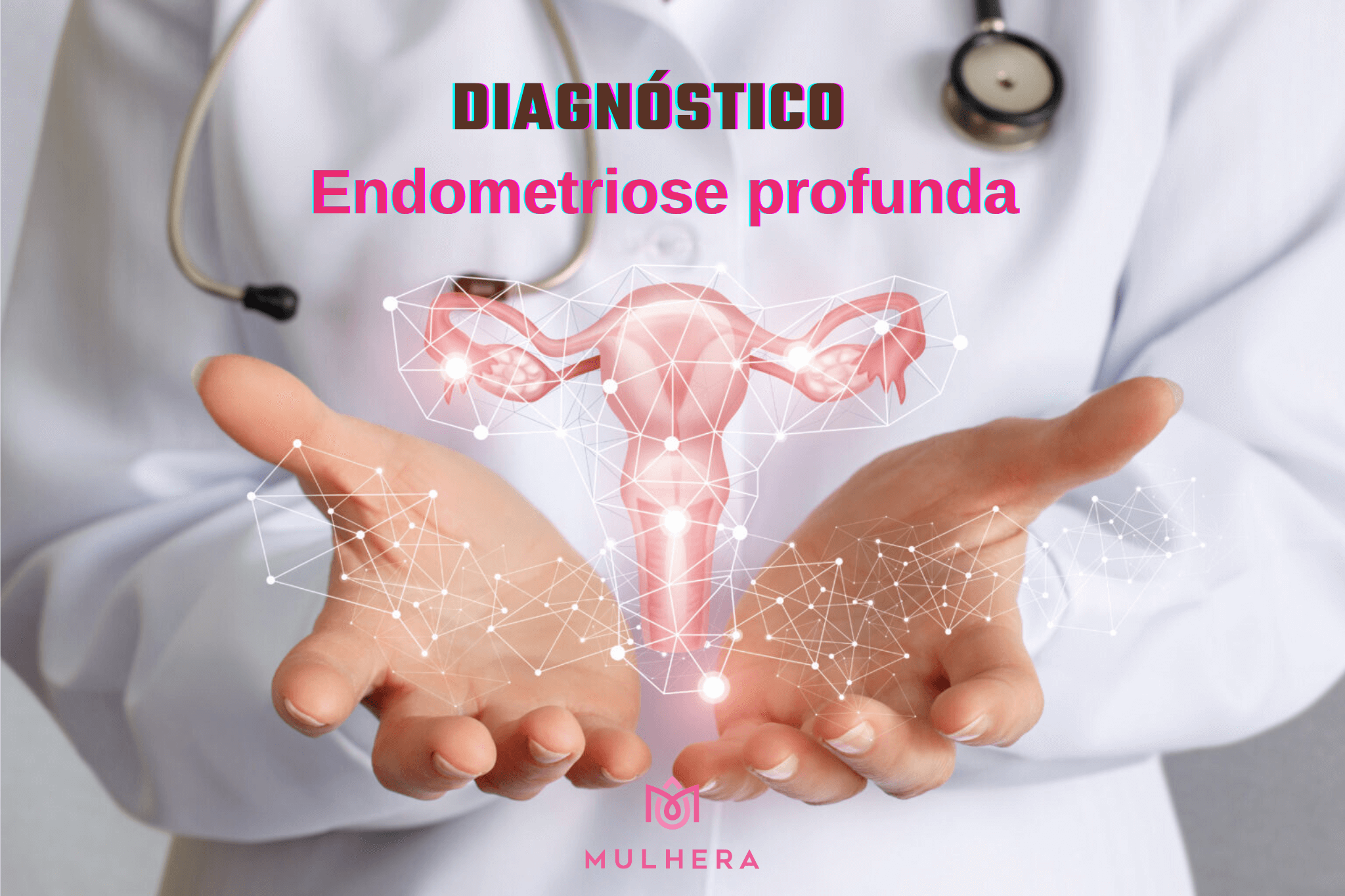 Endometriose profunda