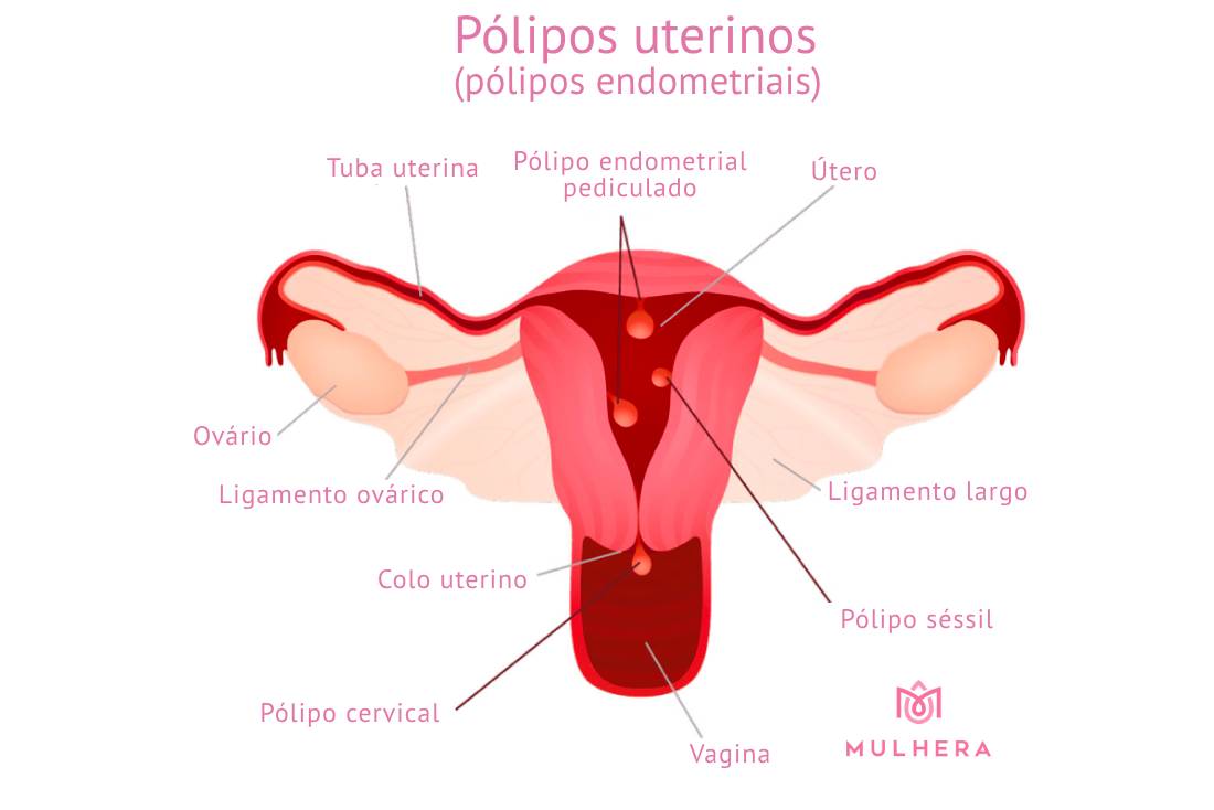 polipo-uterinos