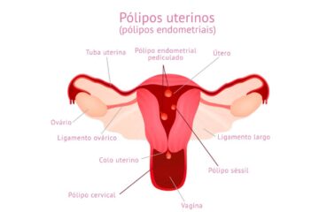 polipo-uterinos