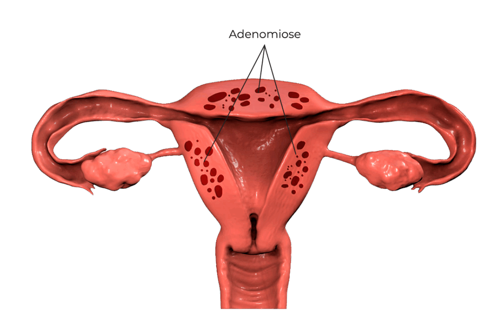 O que causa a adenomiose?