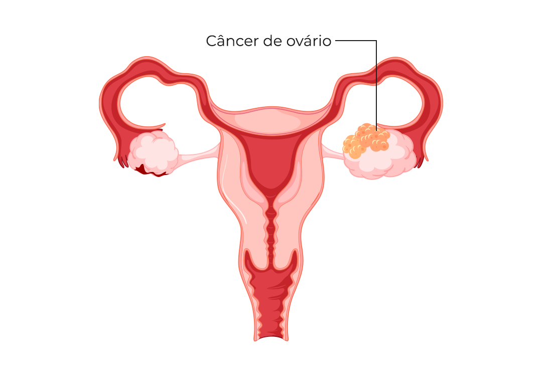 Câncer de ovário