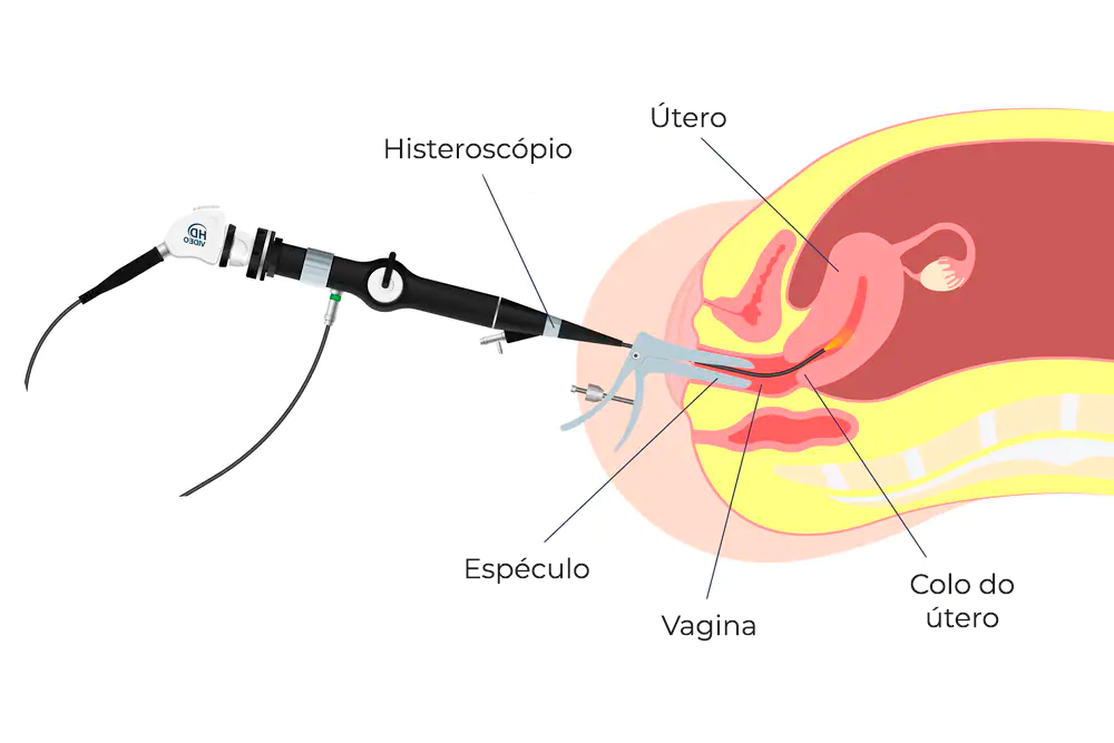 Cirurgia minimamente invasiva histeroscopia