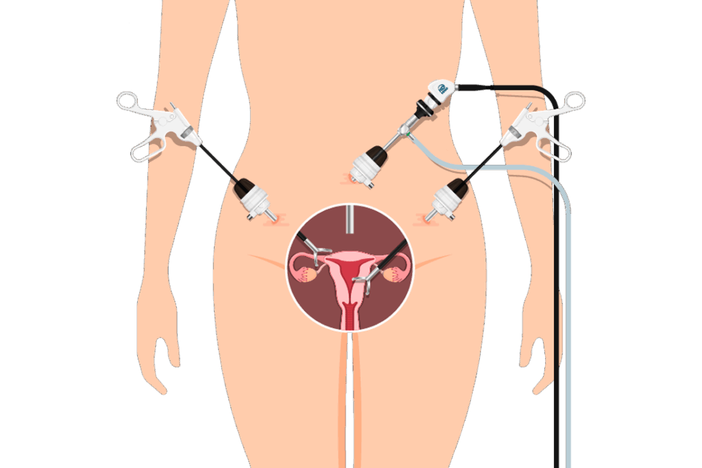 Histeroscopia laparoscópica para o tratamento da adenomiose
