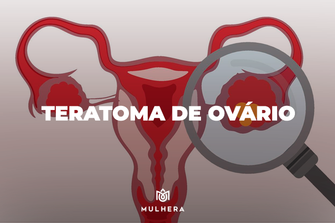 Cisto ovariano - teraroma de ovário