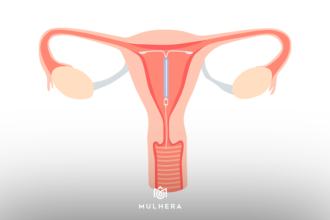 DIU - Dispositivo intrauterino - como é feita a inserção do DIU