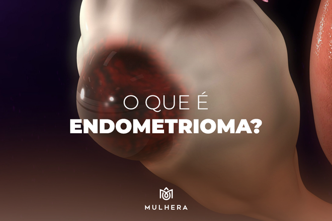 endometrioma endometriose ovariana