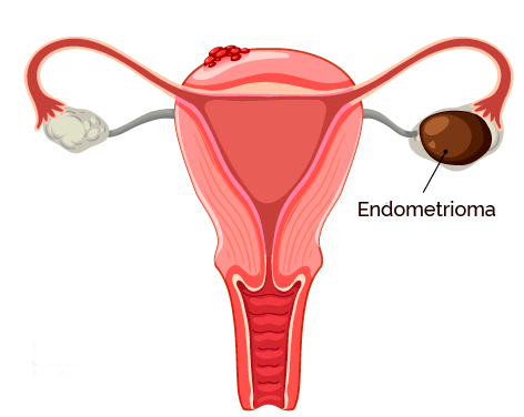 endometrioma, endometriose ovariana, cistos de endometriose ovariana
