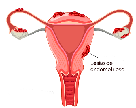 endometriose profunda, lesão de endometriose profunda