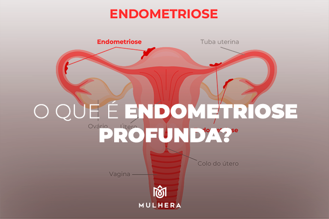 endometriose profunda