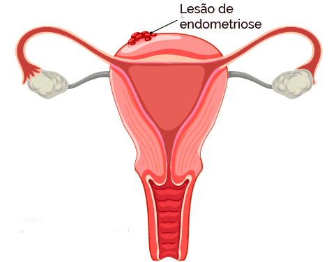 endometriose superficial, lesão de endometriose peritoneal