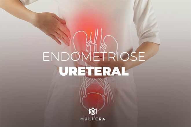 endometriose ureteral, endometriose nos ureteres