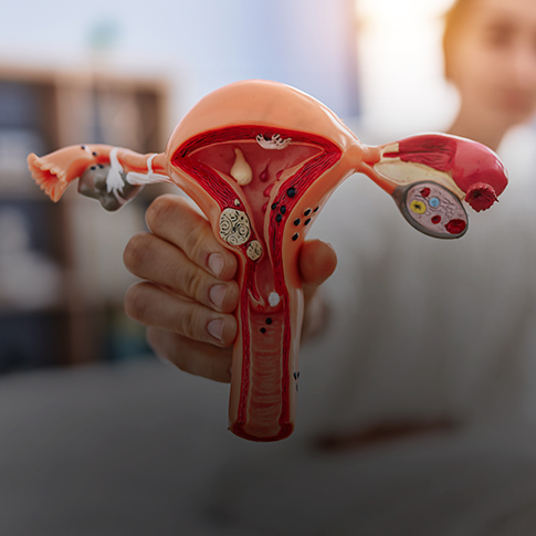 Miomas uterinos, mioma submucoso, mioma intramural, mioma subseroso, mioma pediculado