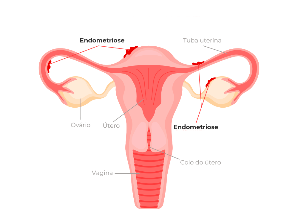 Sistema reprodutor feminino útero, ovário, colo do útero, endometriose